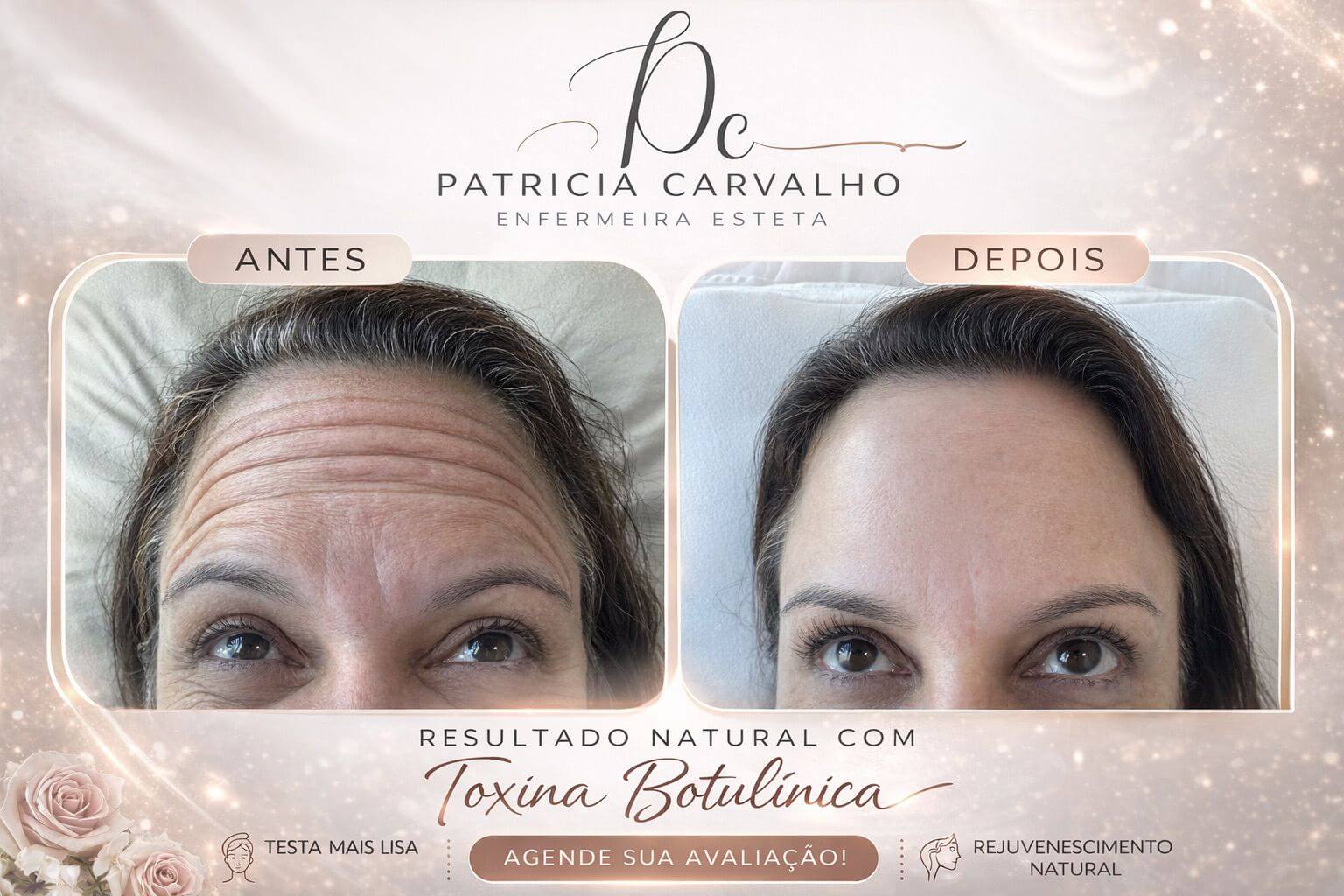 Resultado natural com Toxina Botulínica — antes e depois